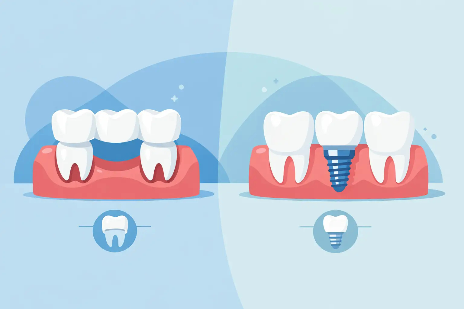 Dental Bridge Versus Implant: Which Fits You?