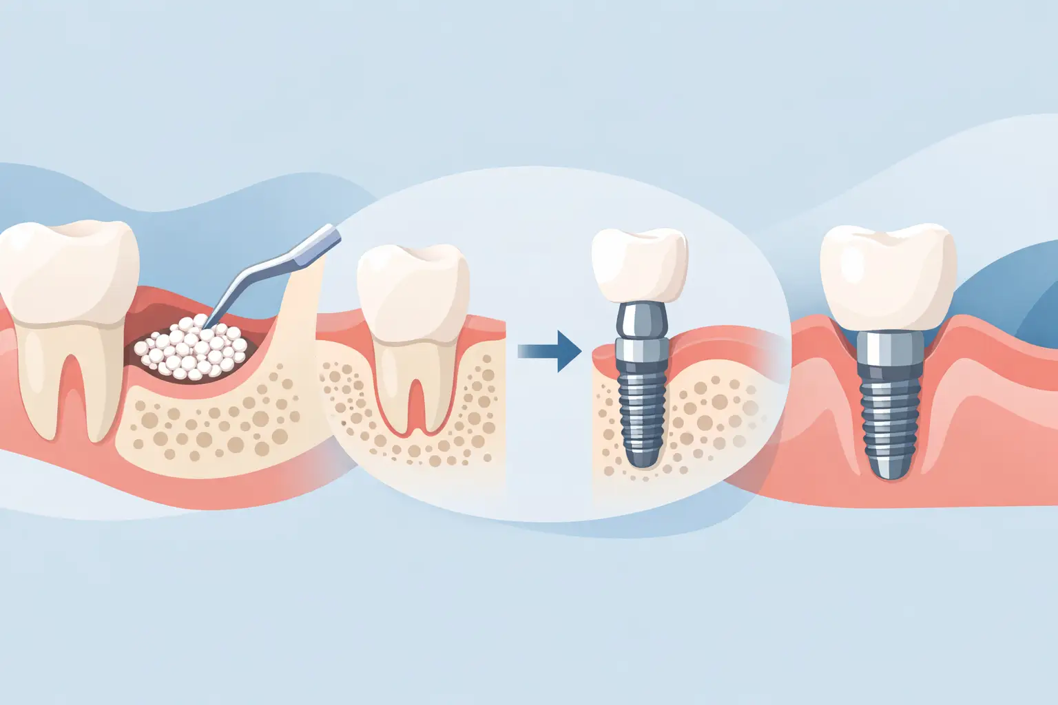 Bone Grafting Before Dental Implants