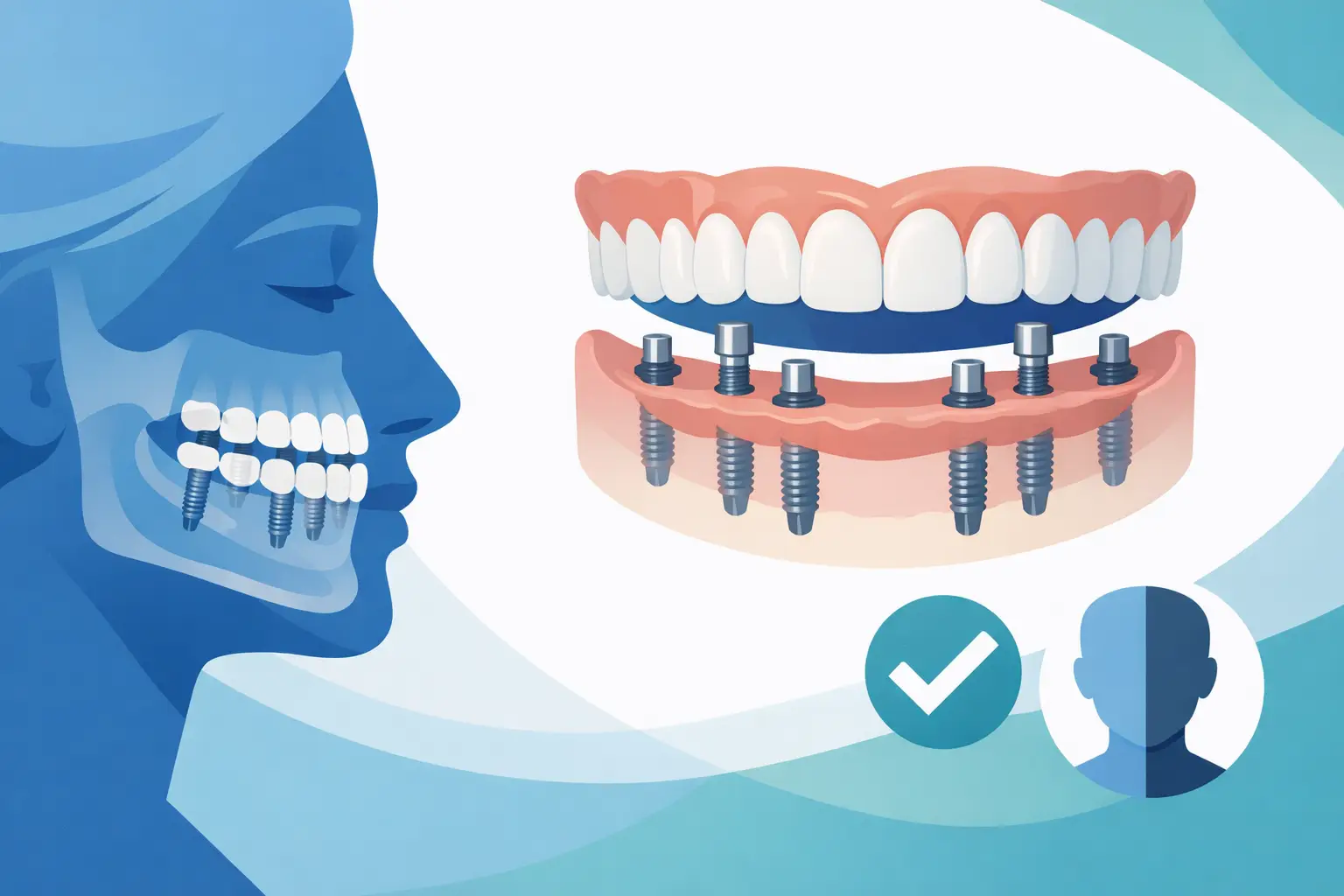 Full Mouth Dental Implants: Is It Right for You?