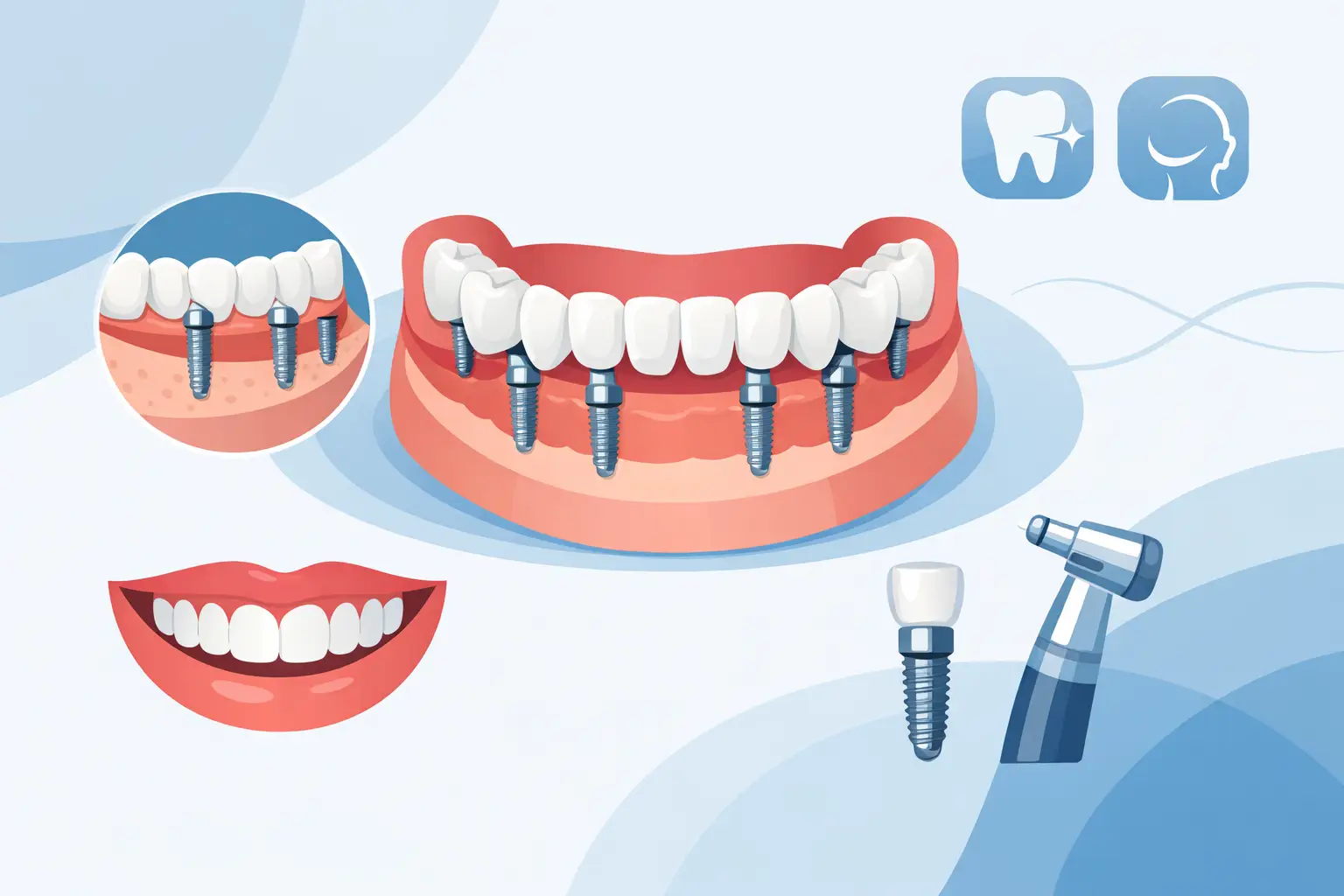 All on 6 Dental Implants for a Full Smile